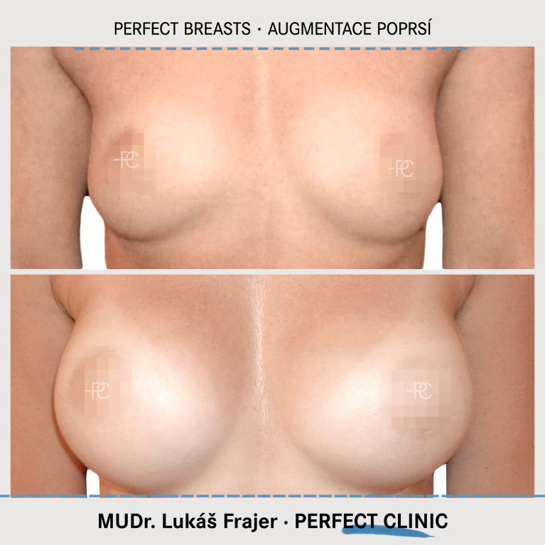 Augmentace poprsí