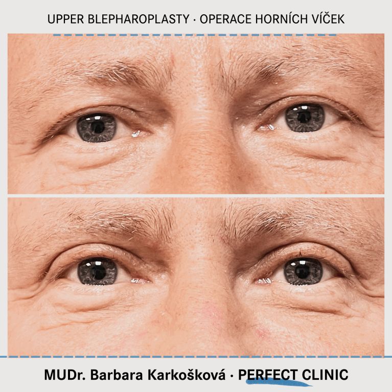 Operace horních víček