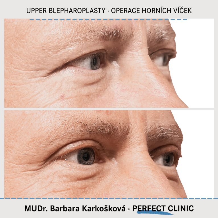 Operace horních víček