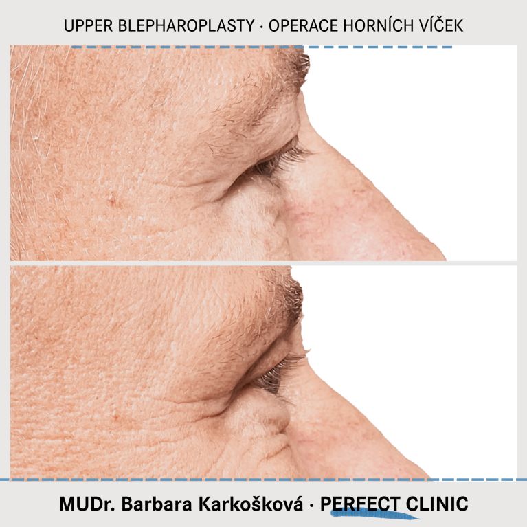 Operace horních víček