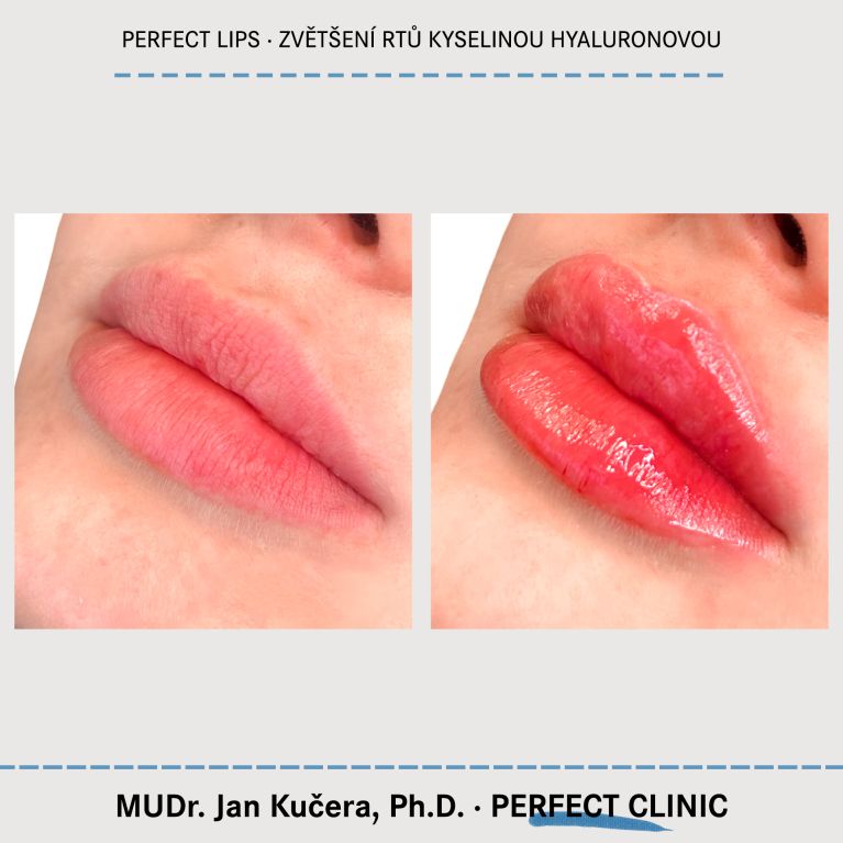 Zvětšení rtů kyselinou hyaluronovou
