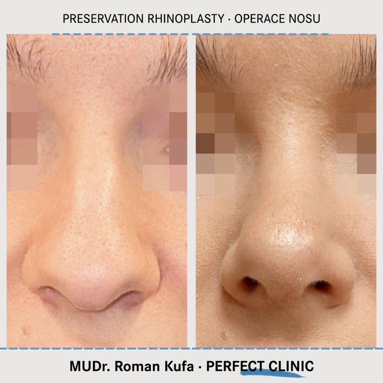 Rhinoplastika