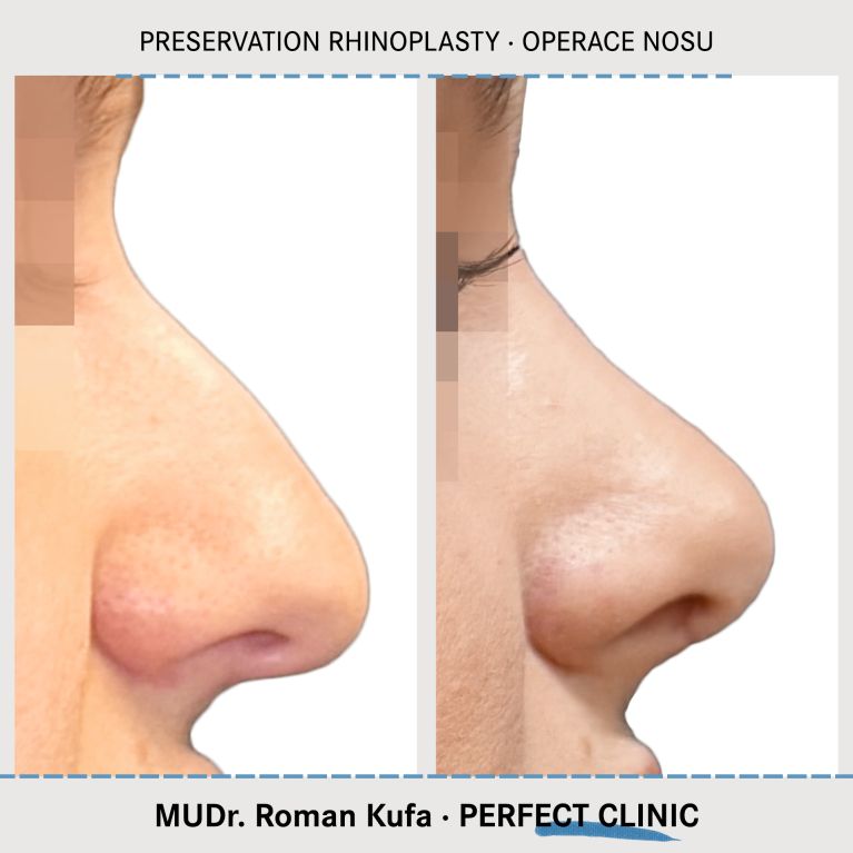 Rhinoplastika