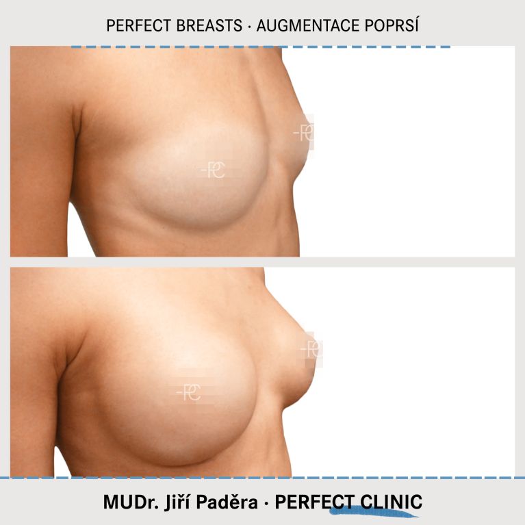 Augmentace poprsí