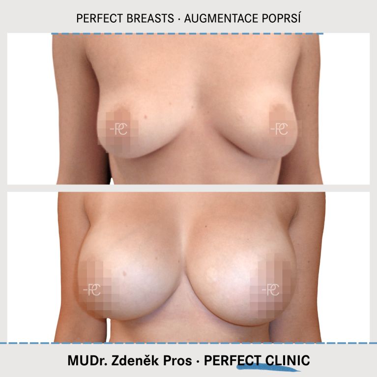 Augmentace poprsí