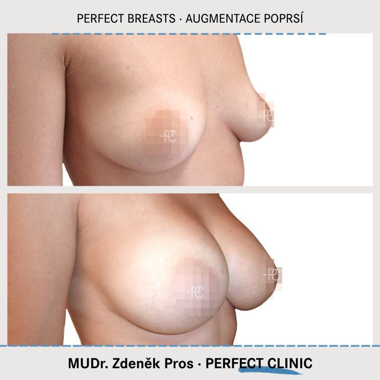 Augmentace poprsí