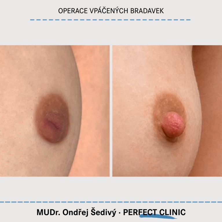 Operace vpáčených bradavek