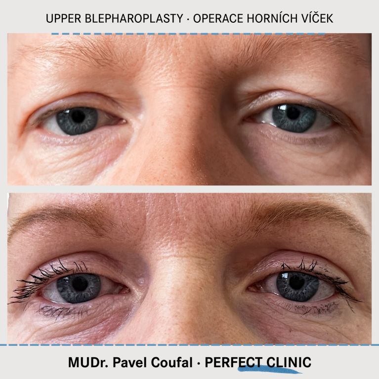 Operace horních víček