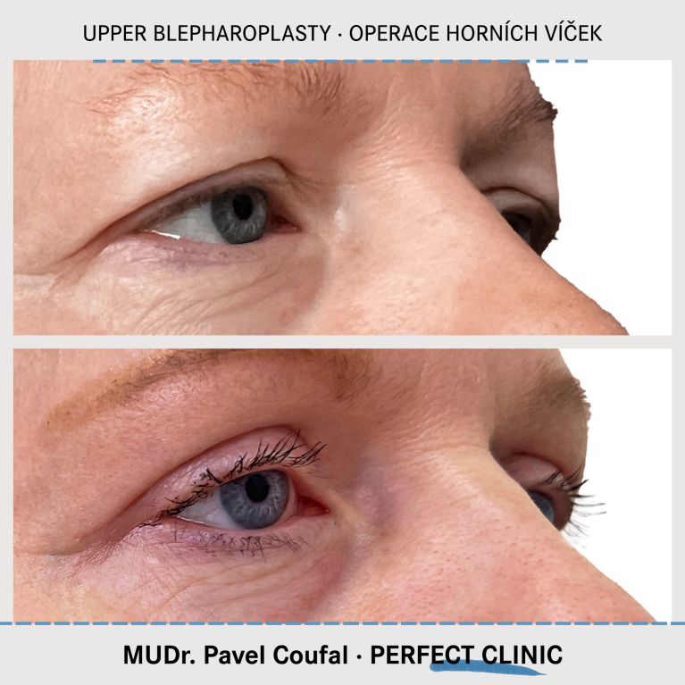 Operace horních víček