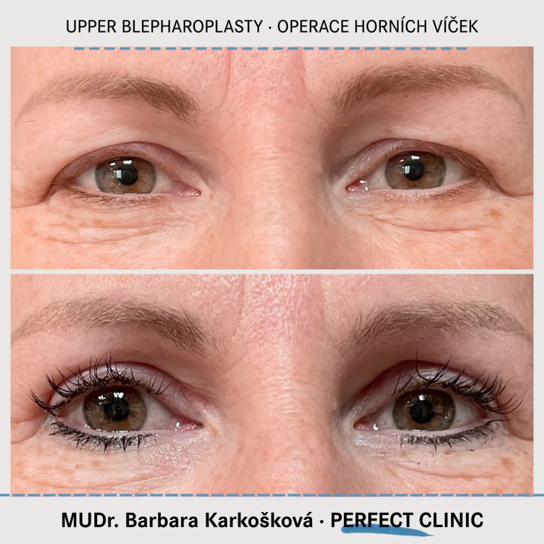 Operace horních víček