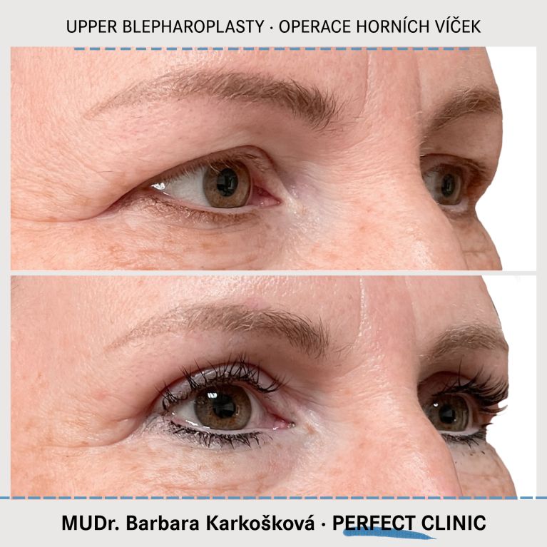 Operace horních víček