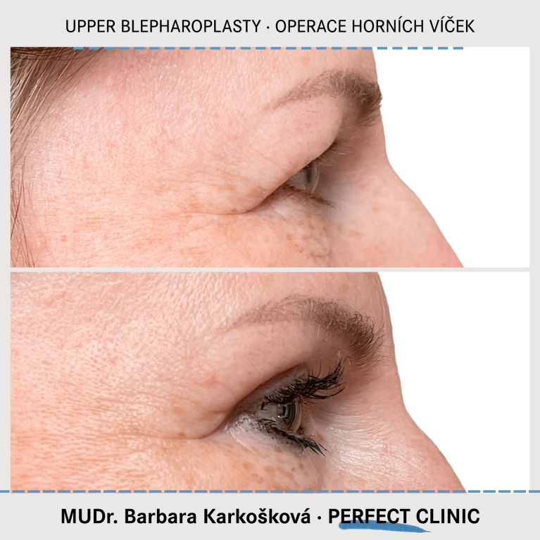 Operace horních víček