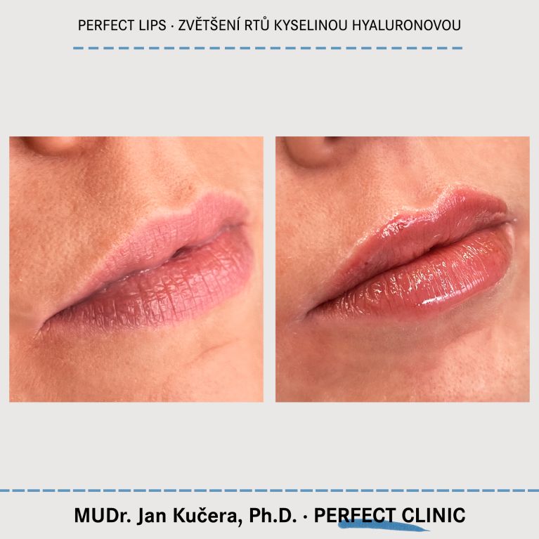 Zvětšení rtů kyselinou hyaluronovou