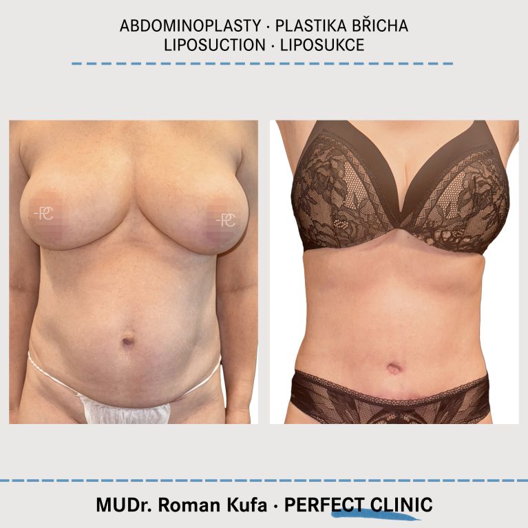 Abdominoplastika & Liposukce