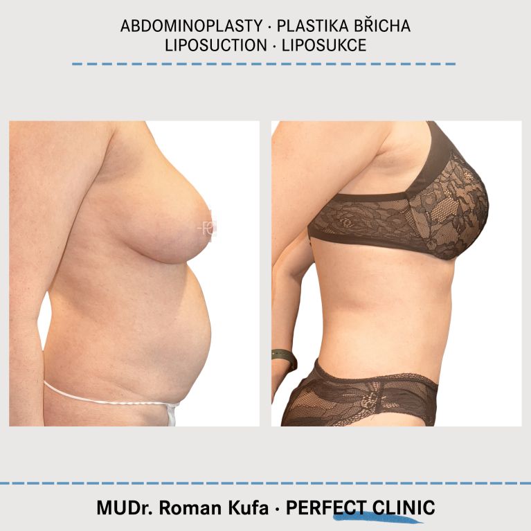 Abdominoplastika & Liposukce