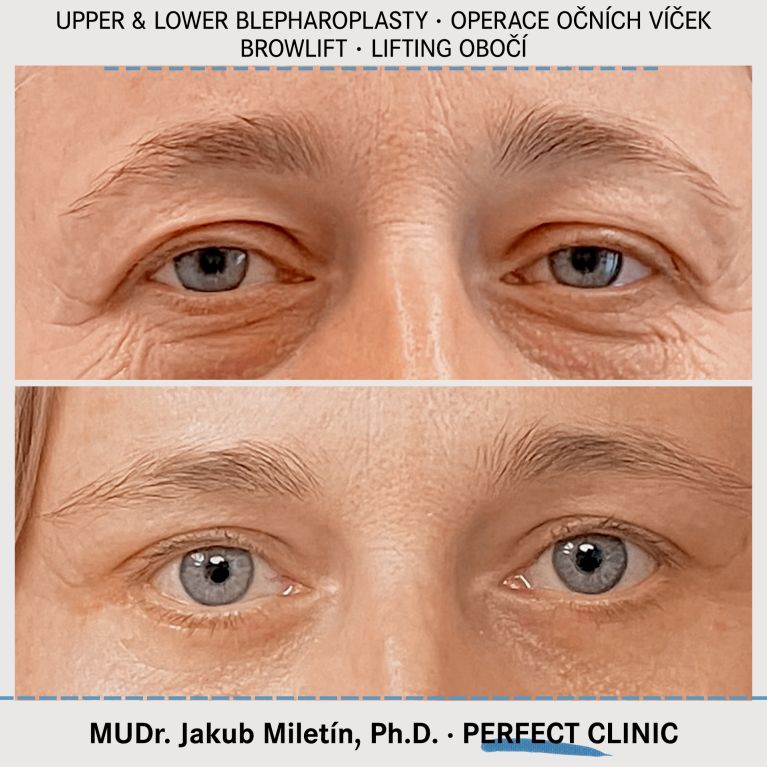 Blepharoplasty • Browlift