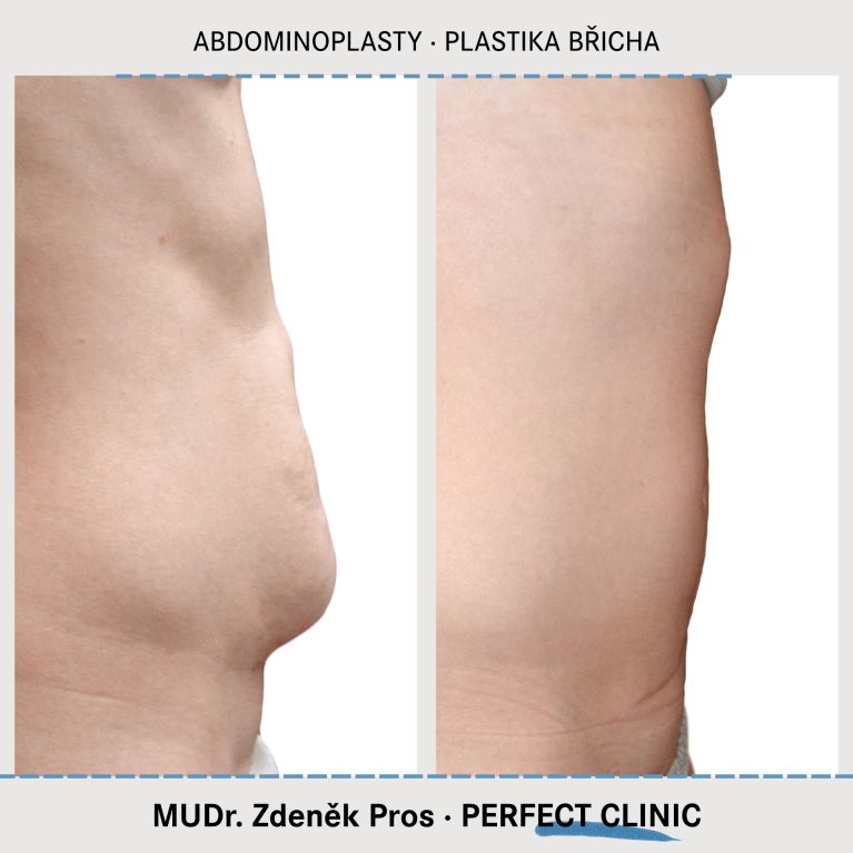Abdominoplastika
