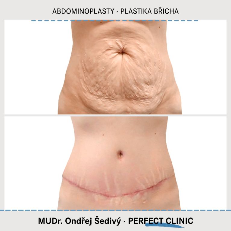 Abdominoplastika