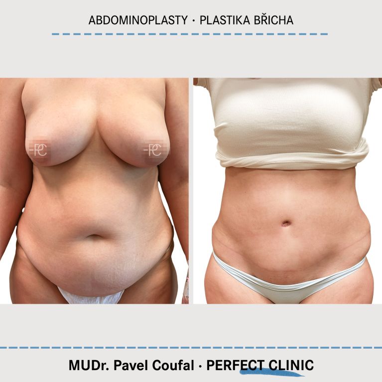 Abdominoplastika