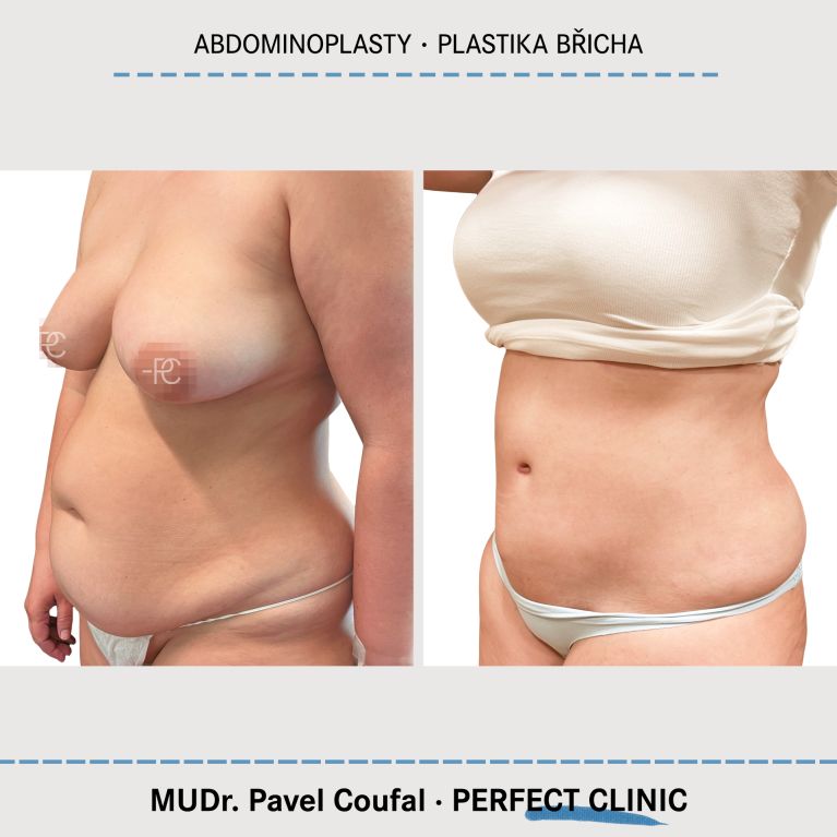 Abdominoplastika