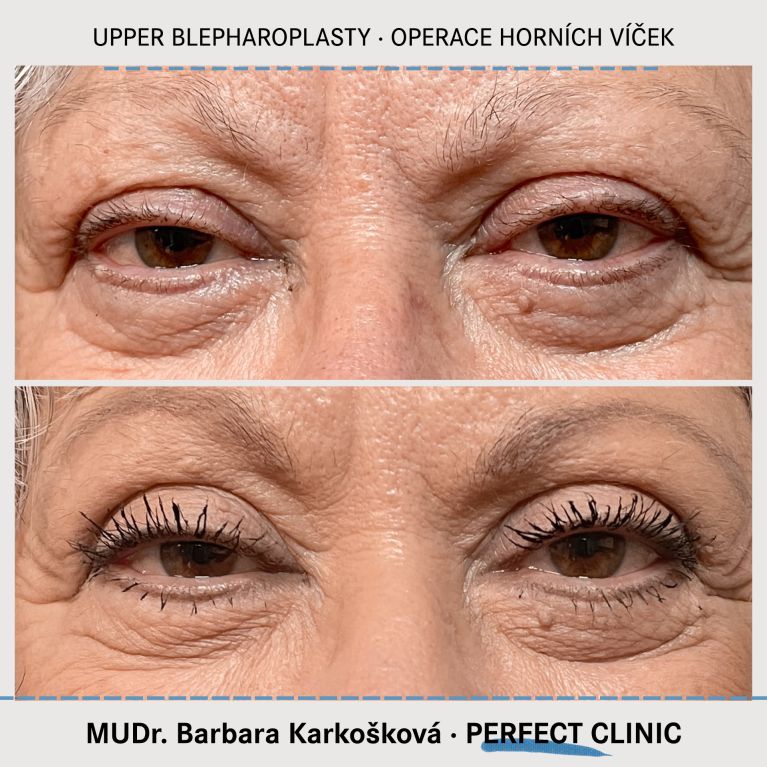 Operace horních víček