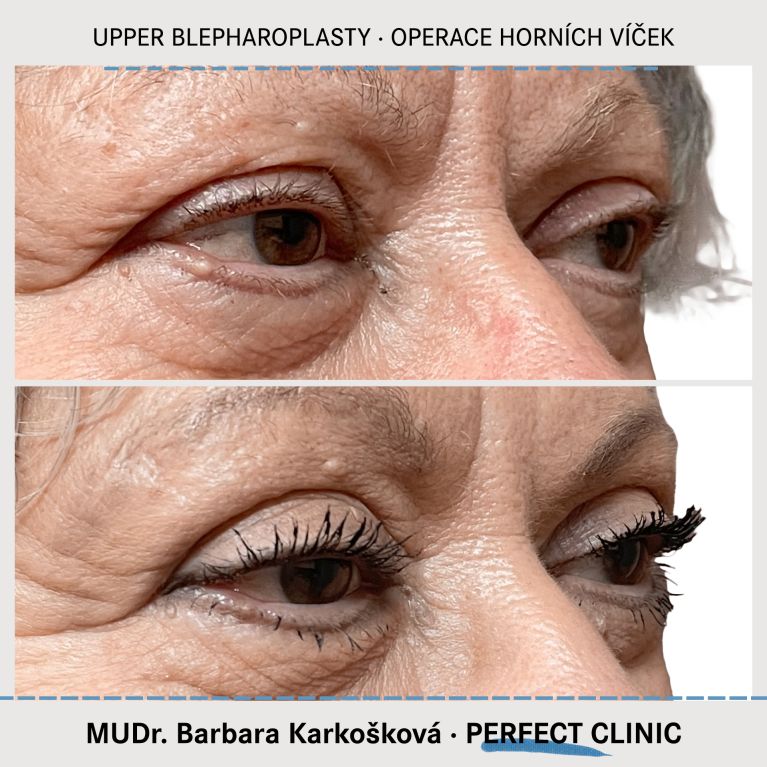 Operace horních víček