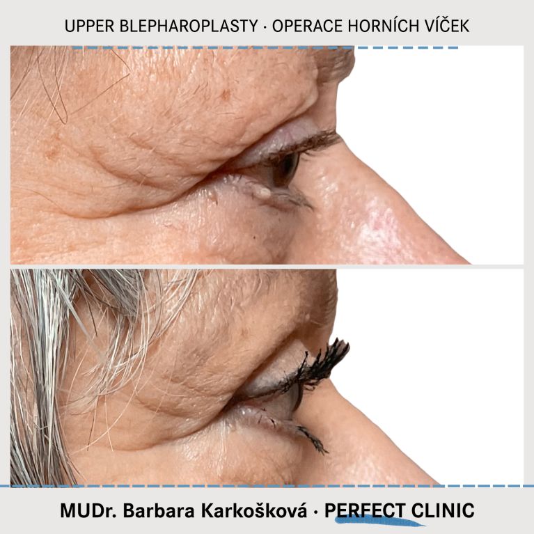 Operace horních víček