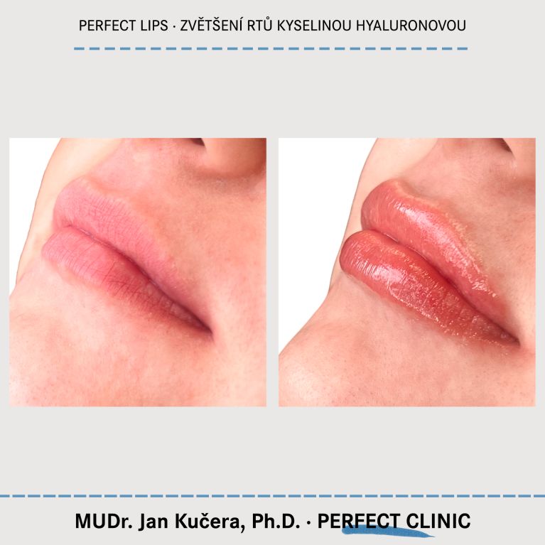 Zvětšení rtů kyselinou hyaluronovou