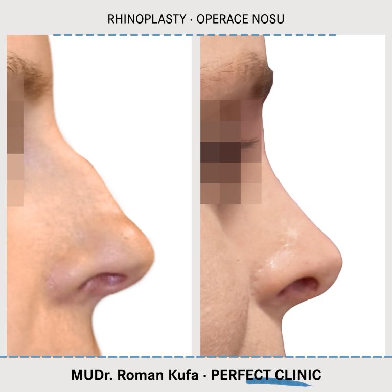 Rhinoplastika