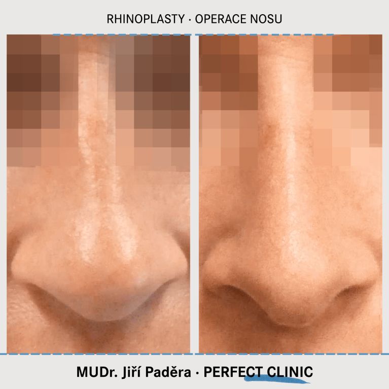 Rhinoplastika