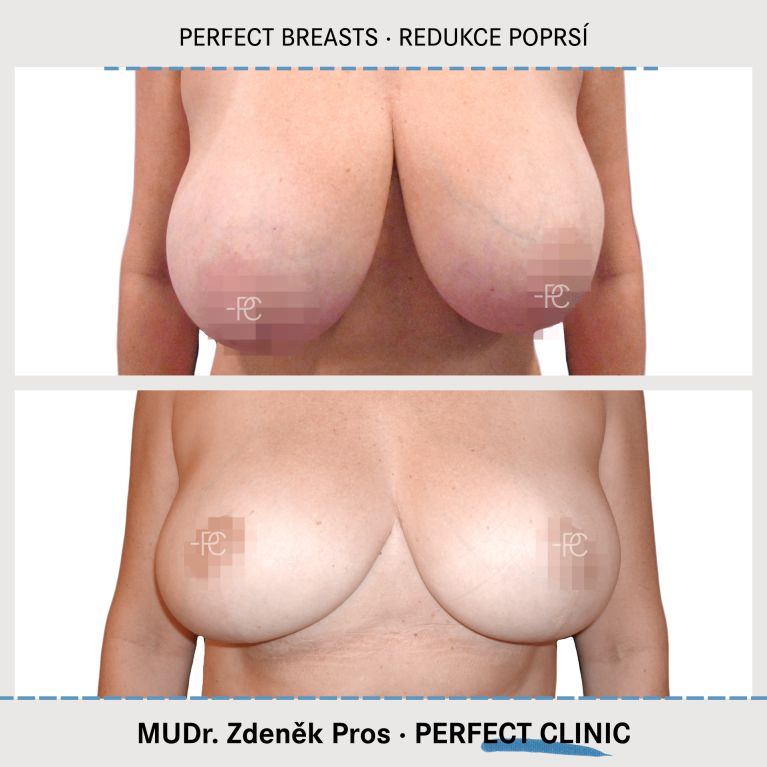 Zmenšení prsou