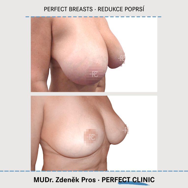 Zmenšení prsou
