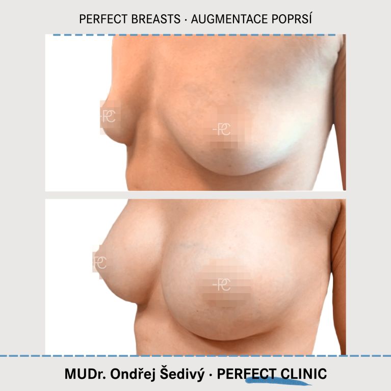Augmentace poprsí