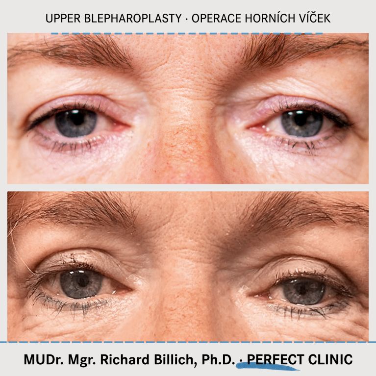 Operace horních víček