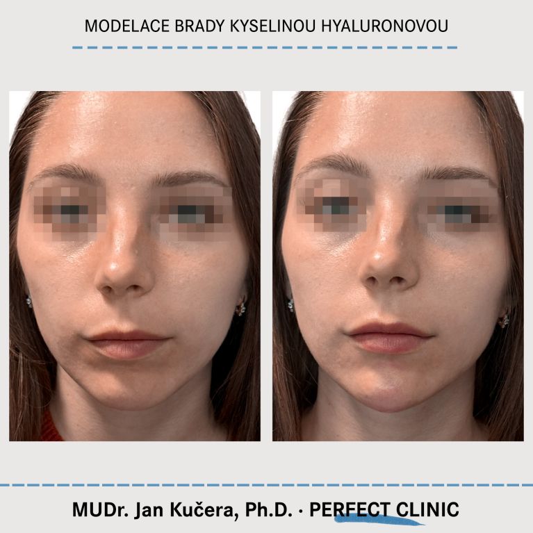 Injekční výplně kyselinou hyaluronovou