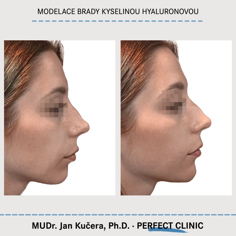 Injekční výplně kyselinou hyaluronovou