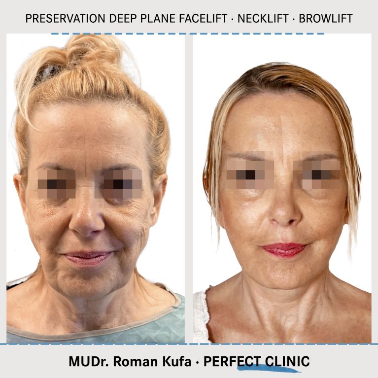 Facelift • Necklift • Browlift