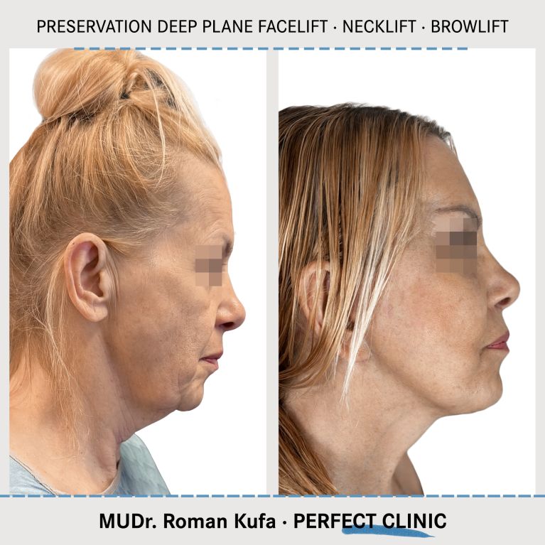 Facelift • Necklift • Browlift