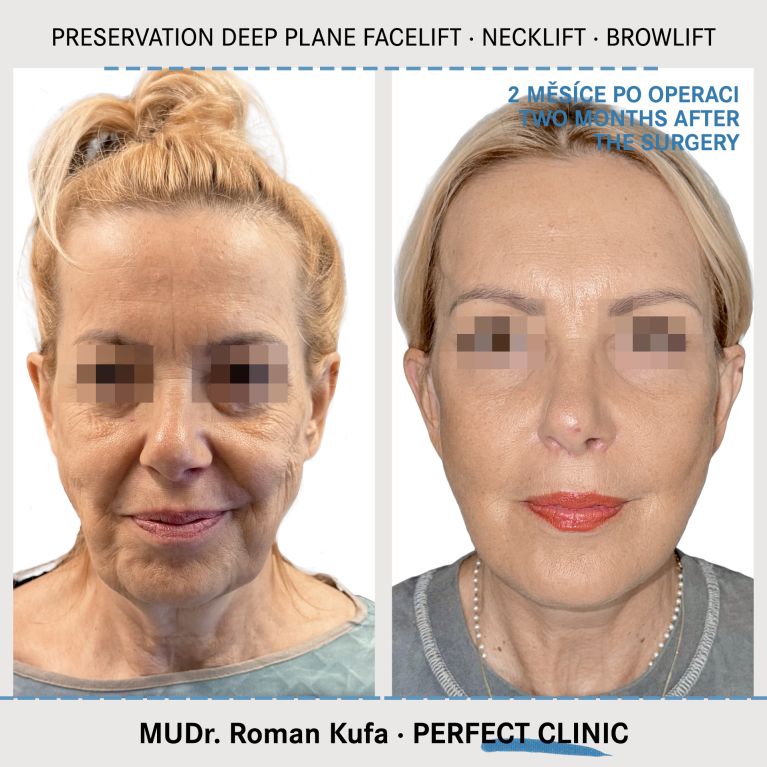 Facelift • Necklift • Browlift