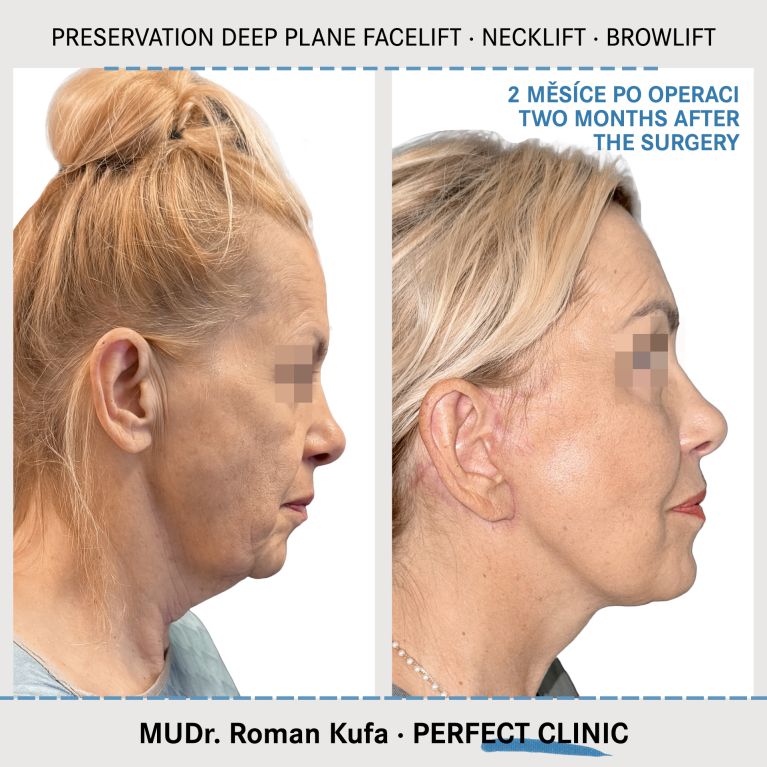 Facelift • Necklift • Browlift