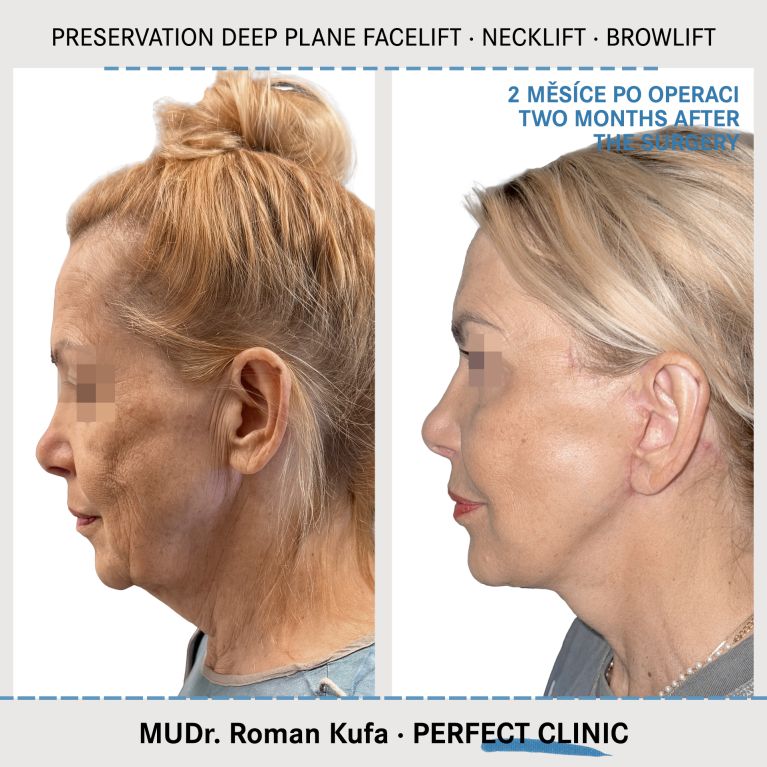 Facelift • Necklift • Browlift