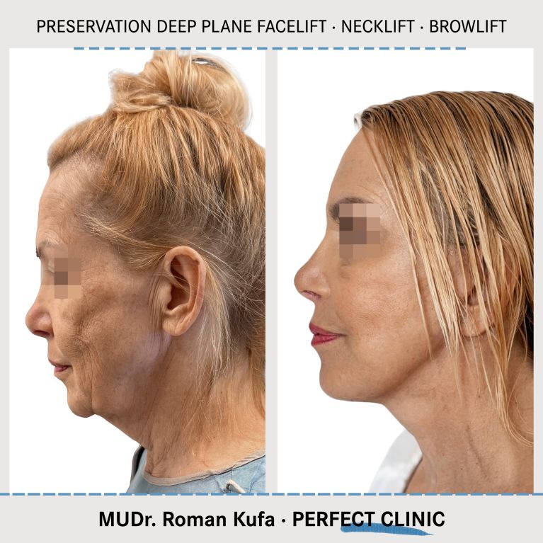 Facelift • Necklift • Browlift