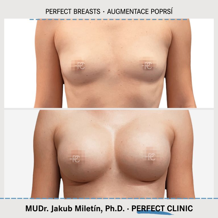 Augmentace poprsí