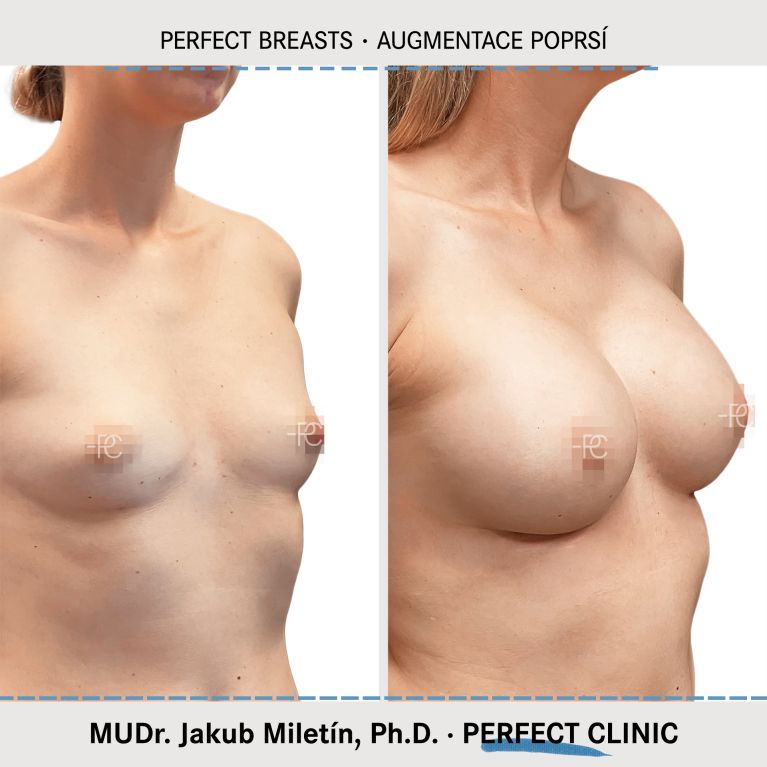 Augmentace poprsí