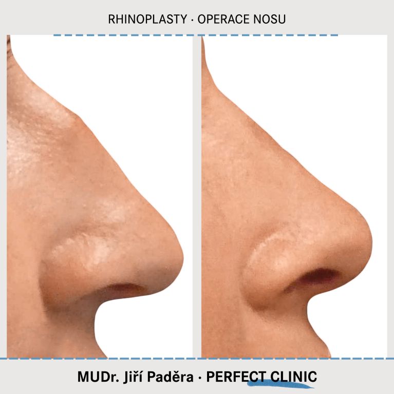 Rhinoplastika