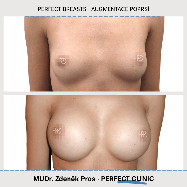 Augmentace poprsí