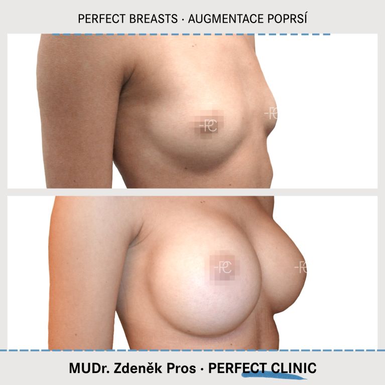 Augmentace poprsí
