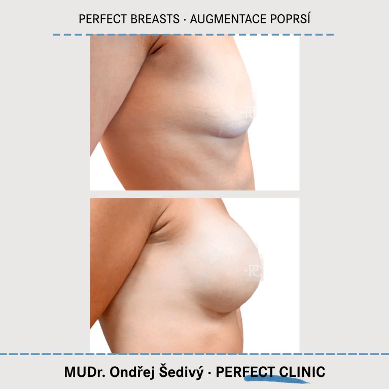 Augmentace poprsí