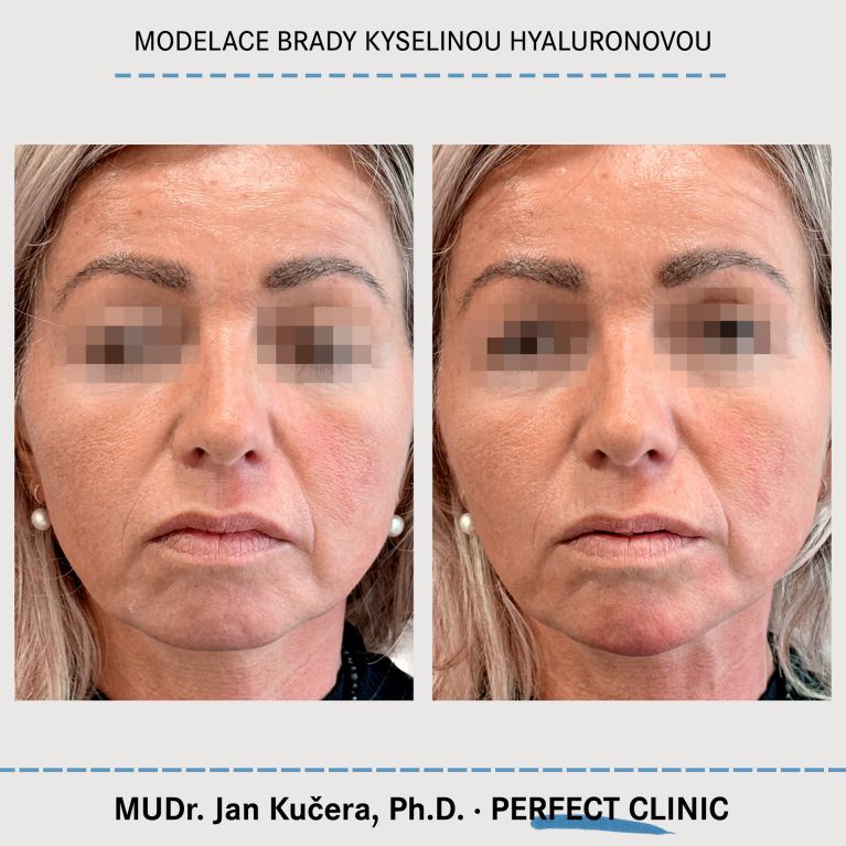 Injekční výplně kyselinou hyaluronovou