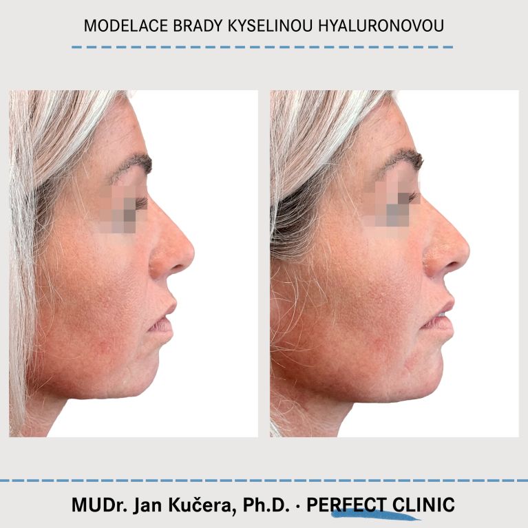 Injekční výplně kyselinou hyaluronovou